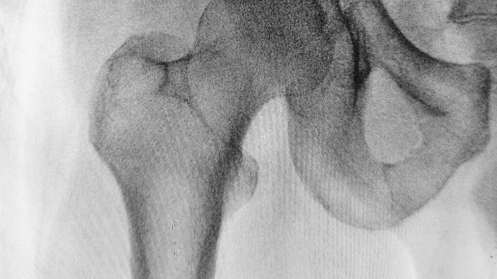 xray of a bone